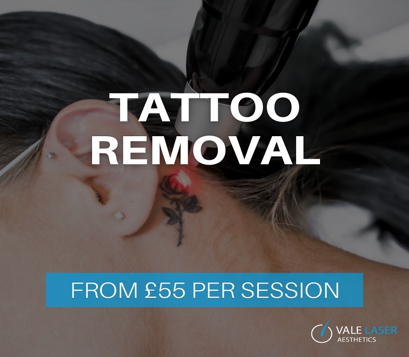 Tattoo Removal in Cardiff