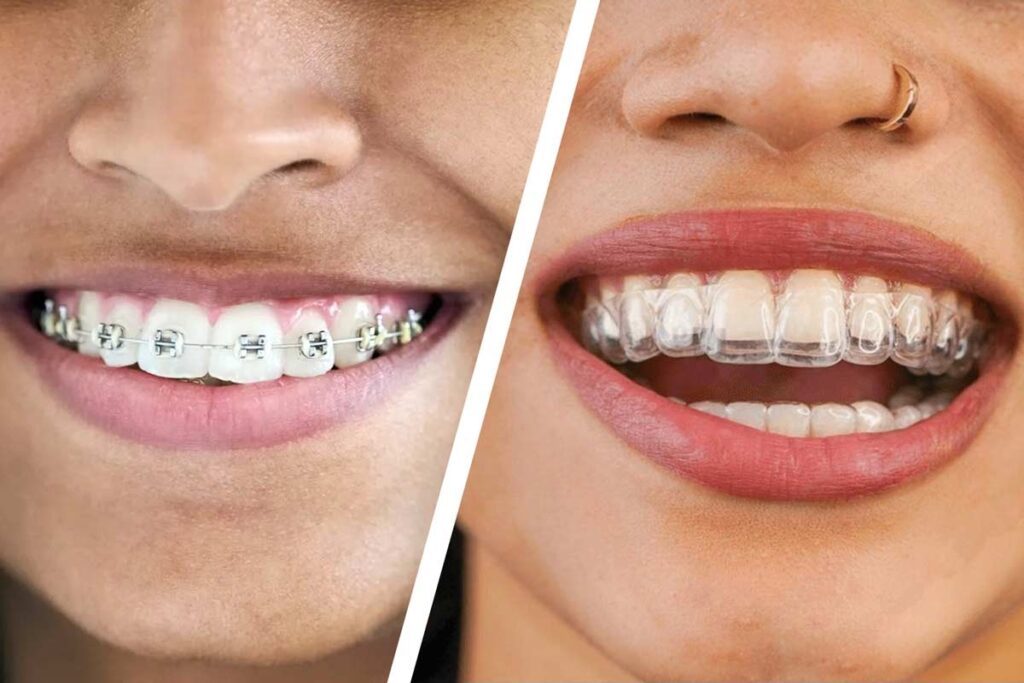 Invisalign in Agoura Hills