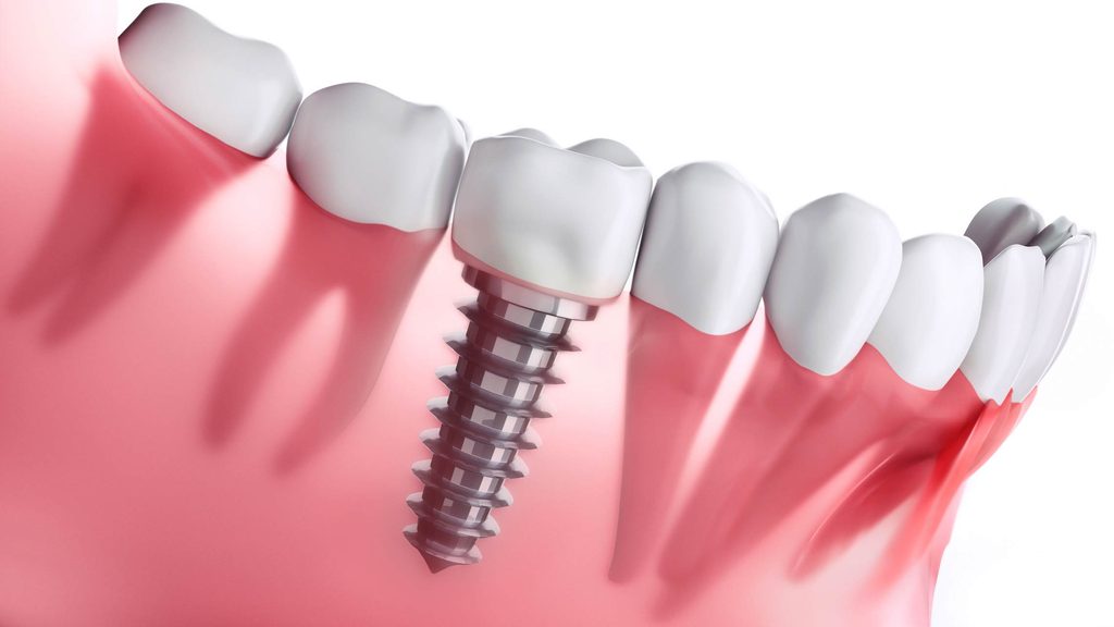 implant dentist near you