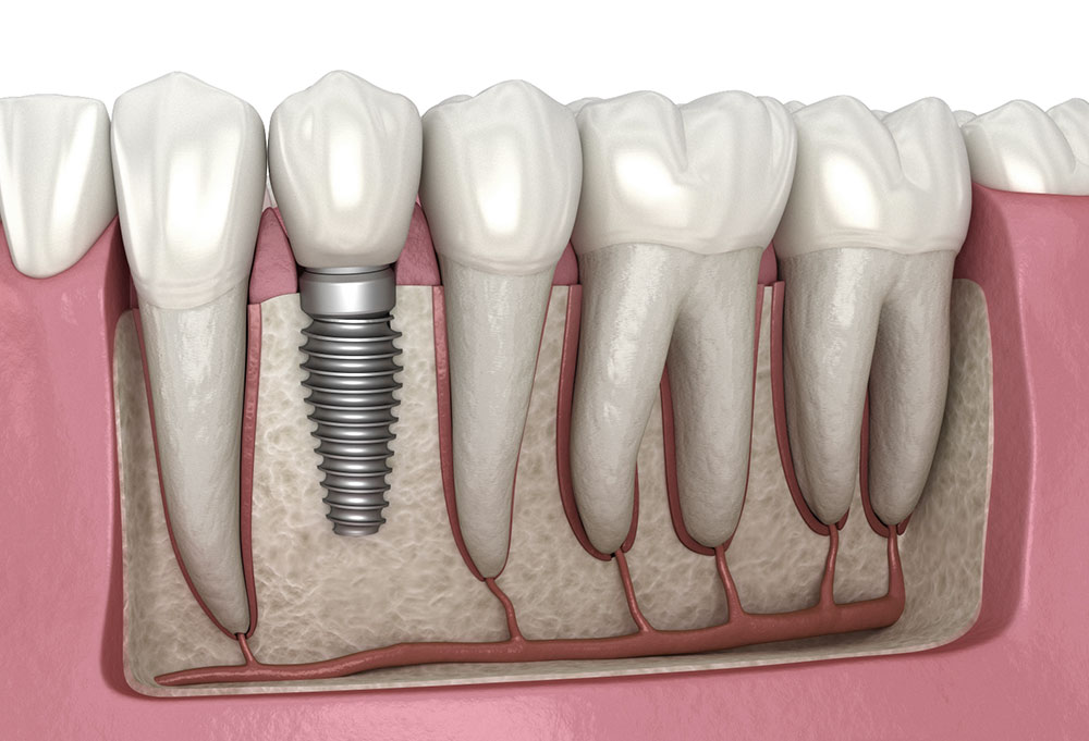 Exploring the Benefits of Dental Implants in Agoura Hills, California