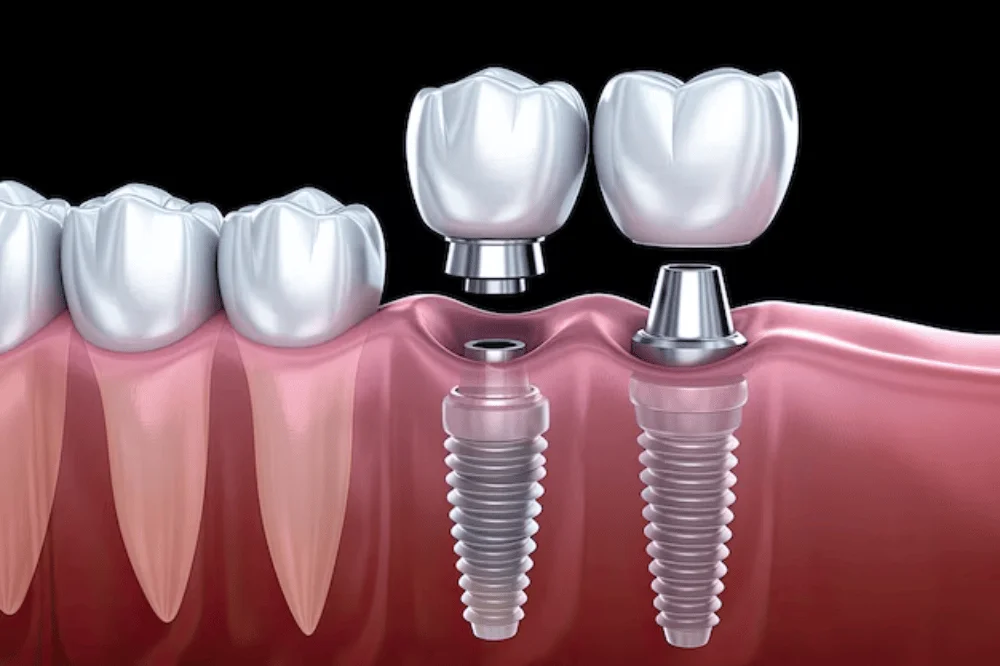 implants in Agoura Hills